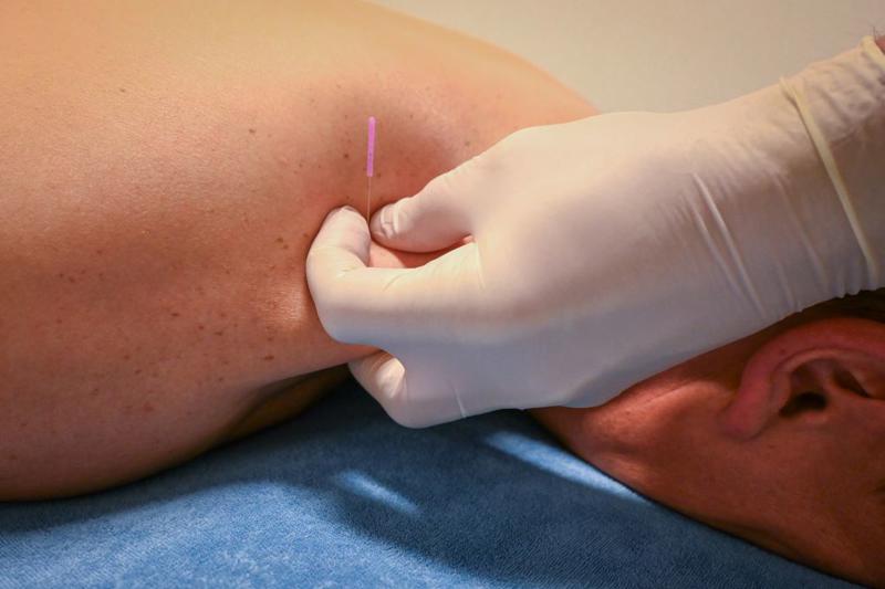 Dry Needling